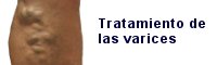 tratar varices toledo